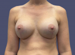 Breast Lift w/Augmentation 2 After